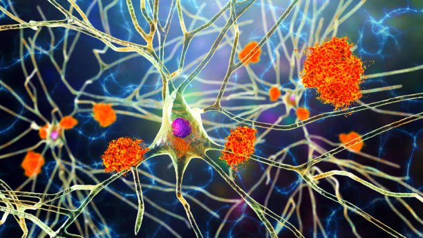 Neurons in Alzheimer's disease. Illustration showing amyloid plaques in brain tissue stock photo