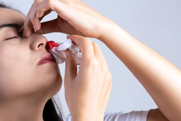 Nosebleed , a young woman with a bloody nose. Healthcare and medical concept. stock photo