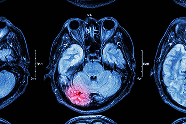 MRI of brain : brain injury stock photo