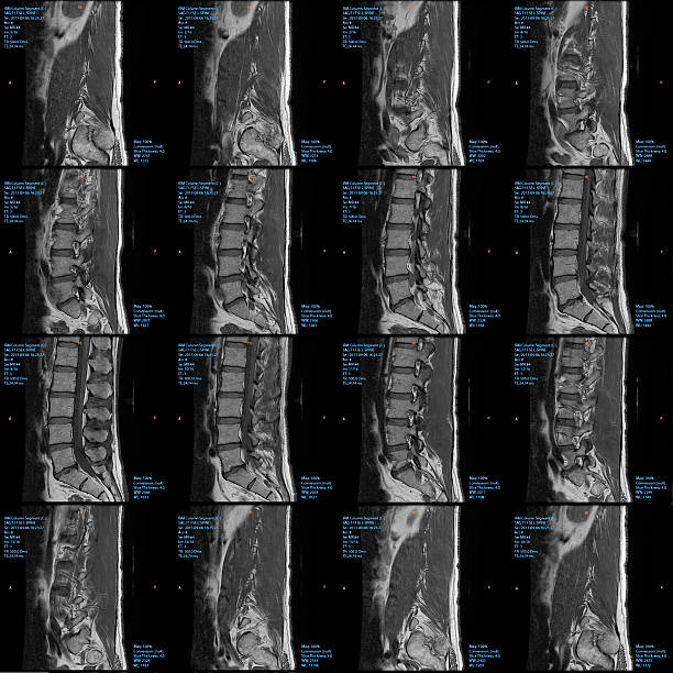 MRI of the Lumbar Spine (spinal column) A mosaic 360 degree lumbar spine magnetic resonance image from 15 different vantage points circling the spine. Image shows large extruded disc herniation at L4-L5 causing significant stenosis of the right lateral recess of the spinal canal and compression of the descending right L5 nerve root.  cauda equina photos stock pictures, royalty-free photos & images