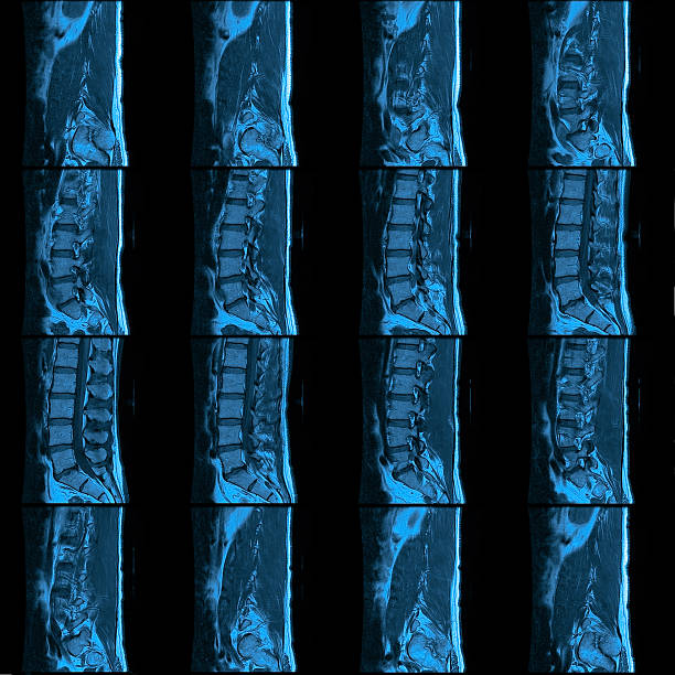 MRI of the Lumbar Spine (lower spinal column) Mosaic 360 degree lumbar spine (lower back) magnetic resonance image from 15 different vantage points circling the spine. Image shows large extruded disc herniation at L4-L5 causing significant stenosis of the right lateral recess of the spinal canal and compression of the descending right L5 nerve root.  cauda equina photos stock pictures, royalty-free photos & images