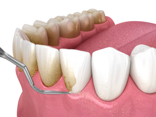 Oral hygiene: Scaling and root planing (conventional periodontal therapy). Medically accurate 3D illustration of human teeth treatment stock photo