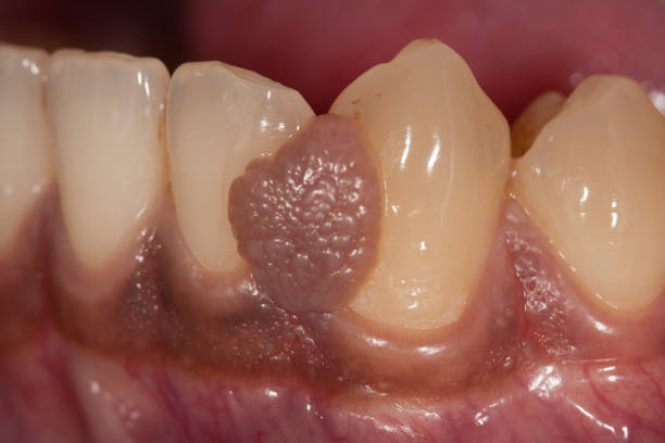 Oral pyogenic granuloma. stock photo