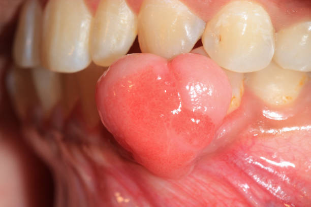 Oral Pyogenic Granuloma. stock photo