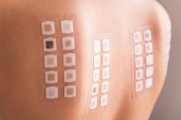 Patch test on back of female patient Allergy patch test on the back of a young woman allergy medicine stock pictures, royalty-free photos & images