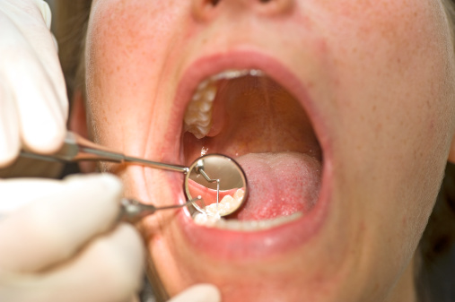 Free trial teeth whitening