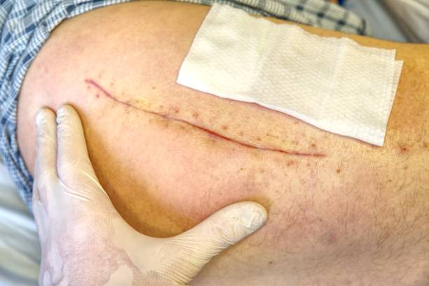 Pacemaker Scar Stock Photos, Pictures & RoyaltyFree Images iStock