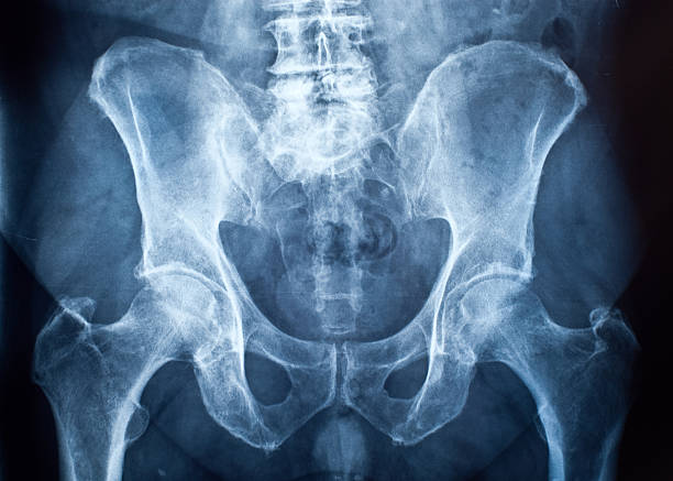Pelvis x-ray stock photo