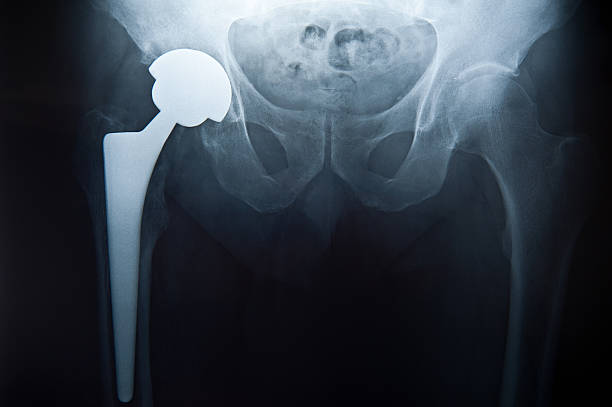 Pelvis X-Ray with hip replacement stock photo