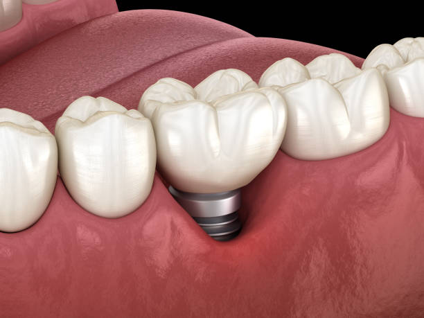 Peri-implantitis with visible gum recession. Medically accurate 3D illustration of dental implants concept stock photo