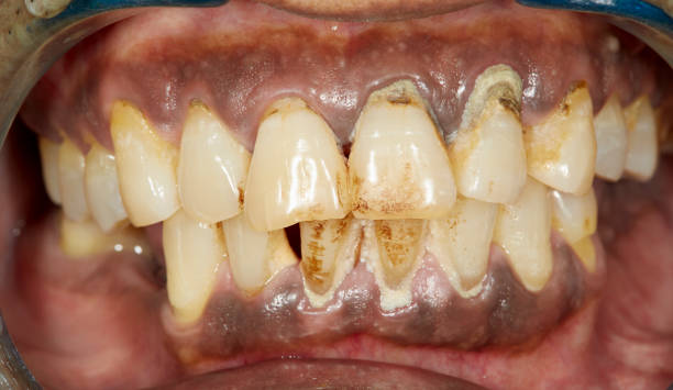 periodontitis stock photo