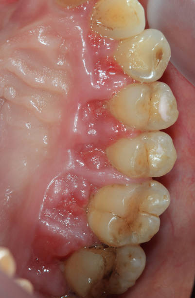 periodontitis. stock photo