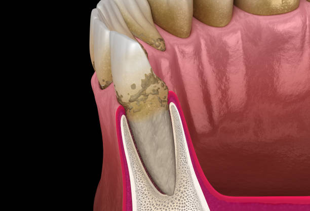 Periodontitis stage 1, gum recession, tartar. Medically accurate 3D illustration Periodontitis stage 1, gum recession, tartar. Medically accurate 3D illustration lateral surface photos stock pictures, royalty-free photos & images