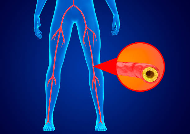 Peripheral arterial disease is the accumulation of fat and calcium in the walls of the arteries of the lower limbs preventing blood flow stock photo