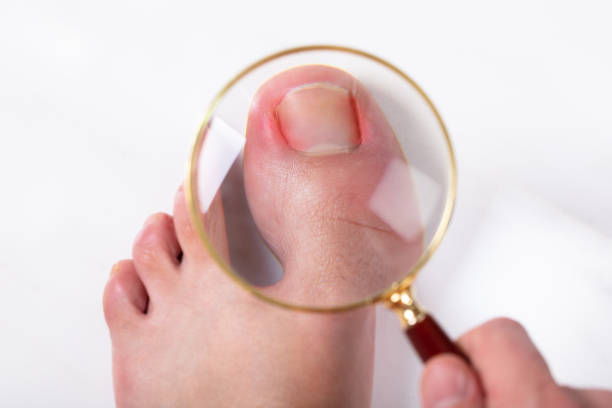 Person Holding Magnifying Glass Over Sore Toe Nail An Overhead View Of Person's Hand Holding Magnifying Glass Over Sore Toe Nail On Floor toenail stock pictures, royalty-free photos & images