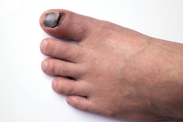 Toe Nail With Bruise Stock Photos, Pictures & Royalty-Free Images - iStock