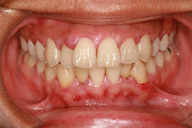 A photograph of a mouth displaying gingivitis stock photo