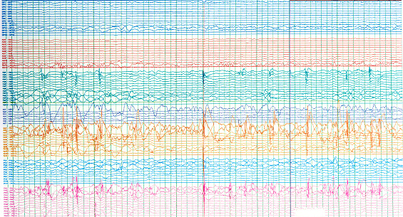 Photography of human electroencephalograhy of epileptic patient showing sharp wave during  no seizure or interictal EEG.