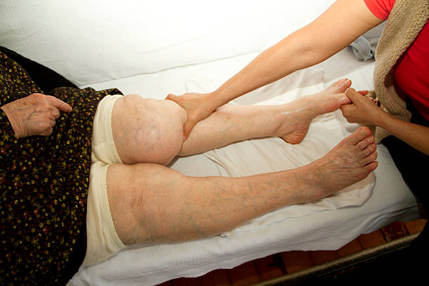 stocarea de la varicoza la genunchi