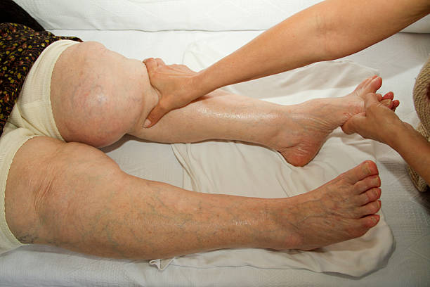 Noduli varicoși pe tratamentul unguentului picioarelor