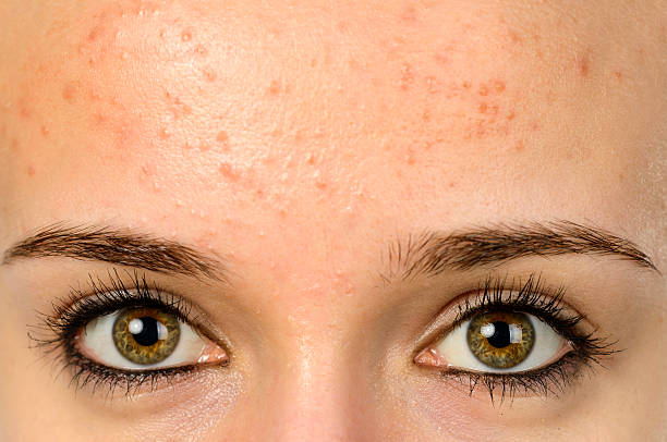 pimples on forehead stock photo
