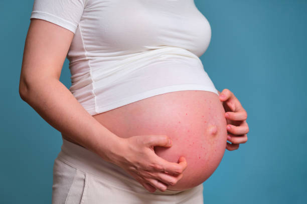 Pimples on the belly of a pregnant woman, studio shot on a blue background Pimples on the belly of a pregnant woman, studio shot on a blue background pregnancy acne stock pictures, royalty-free photos & images