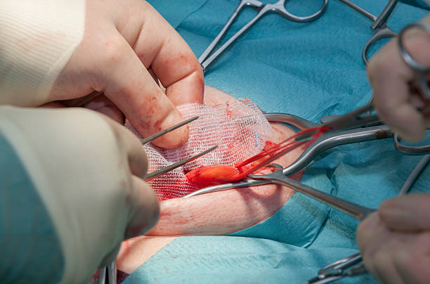 Placing mesh to strengthen the inguinal region during hernia repair The surgeon is placing a mesh to strengthen the inguinal region during open inguinal hernia repair. hernia inguinal stock pictures, royalty-free photos & images