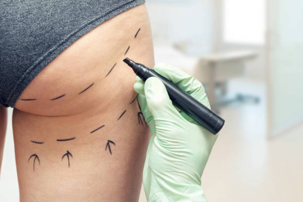 plastisch chirurg markering womans lichaam voor plastische chirurgie - gat stockfoto's en -beelden