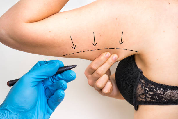 Plastic surgery doctor draw line on patient arm stock photo