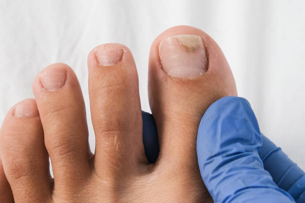 A podologist examines bare foot with onycholysis on a toenail after damaging with tight shoes or using gel-lacquer stock photo