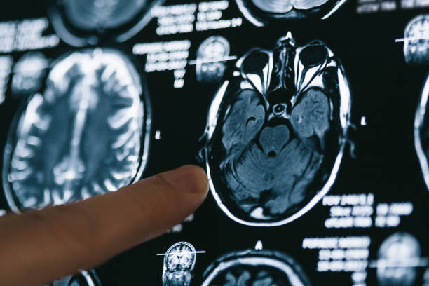 Pointing on X-ray brain image stock photo