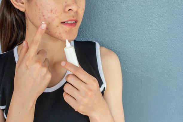 Portrait of woman with acne inflammation (Papule and Pustule) on her face and she trying to applying acne cream on her face for treat. stock photo