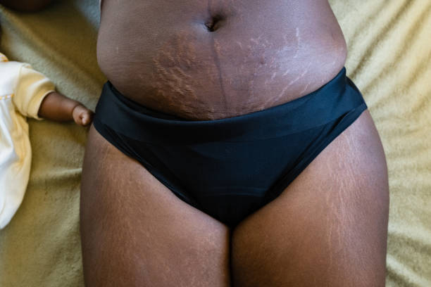 Postpartum stretch marks on the belly stock photo