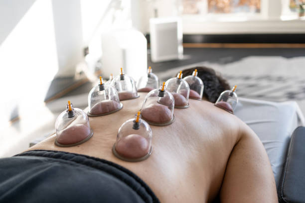 Professional performing vacuum cupping therapy on a client Professional performing vacuum cupping therapy on a client cupping therapy stock pictures, royalty-free photos & images