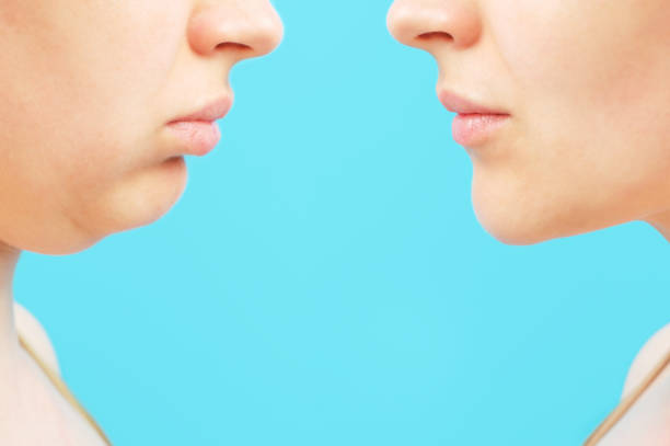 Profile of female face with and without a second chin, concept before and after plastic surgery. stock photo