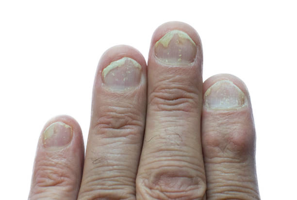 nail psoriasis after injury)