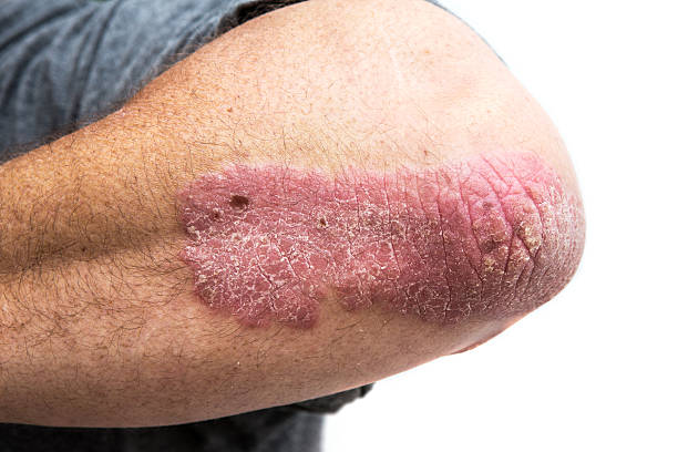 psoriasis on a mid age mans  elbow stock photo