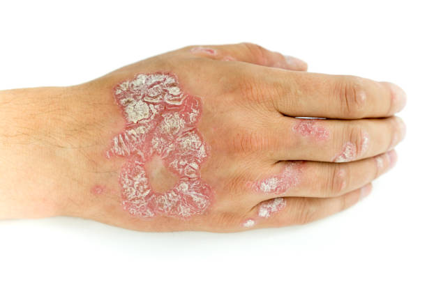 Psoriasis vulgaris and fungus on the man hand and fingers with plaque, rash and patches, isolated on white background. Autoimmune genetic disease. Psoriasis vulgaris and fungus on the man hand and fingers with plaque, rash and patches, isolated on white background. Autoimmune genetic disease. animal scale photos stock pictures, royalty-free photos & images
