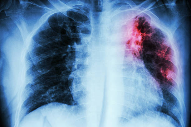 Pulmonary Tuberculosis Pulmonary Tuberculosis .  Chest X-ray : interstitial infiltration at left upper lung due to Mycobacterium Tuberculosis infection deficiency condition stock pictures, royalty-free photos & images