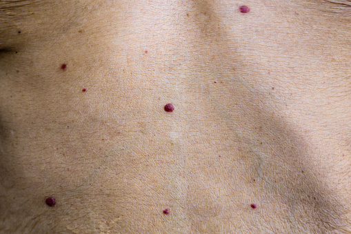 Red moles, or cherry angiomas, are common skin growths that can develop on most areas of your body. They