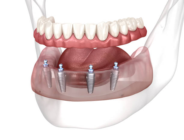 Removable mandibular prosthesis All on 4 system supported by implants. Medically accurate 3D illustration of human teeth and dentures concept stock photo