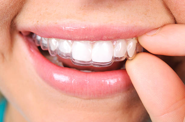 tarpon springs invisalign treatment