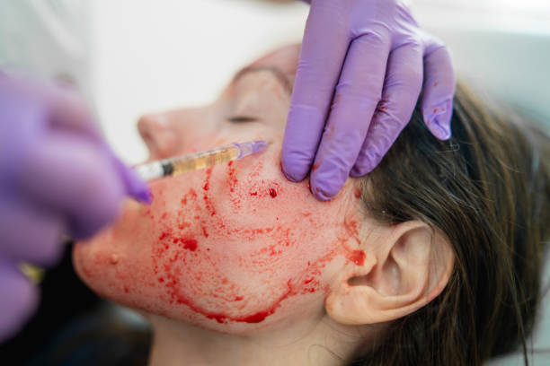 Revolutionary treatment of rejuvenation with blood plasma Close-up photo of doctor applying blood plasma during PRP vampire facelift. infusion therapy stock pictures, royalty-free photos & images