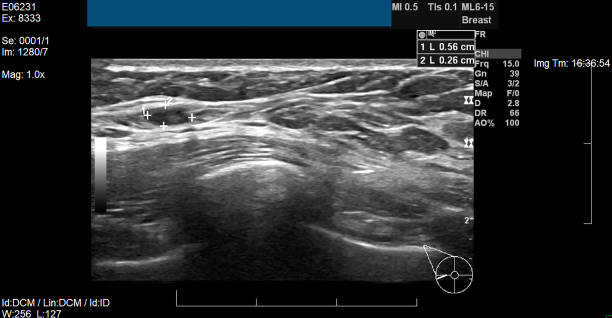 Right Breast and Armpit (Axillary) Ultrasound stock photo