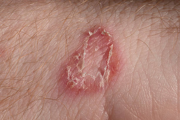 Ringworm on white man / Mycosis Ringworm on white man skin / Fungus Infection / Mycosis fungus photos stock pictures, royalty-free photos & images