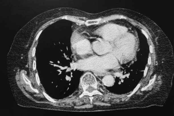 CT scan (computed tomography) of chest organs. stock photo