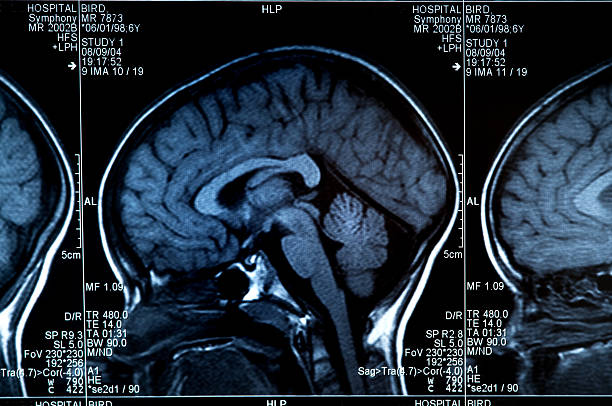 MRI scan of human brain and skull stock photo