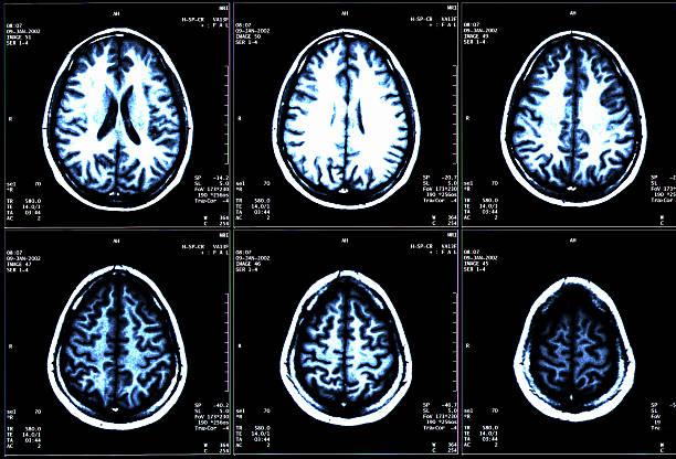 MRI Scan  multiple sclerosis stock pictures, royalty-free photos & images