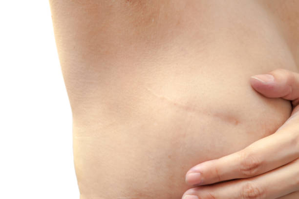 Scar from breast cancer operation stock photo