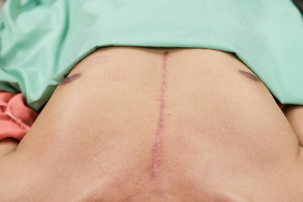 Scar from open heart surgery stock photo